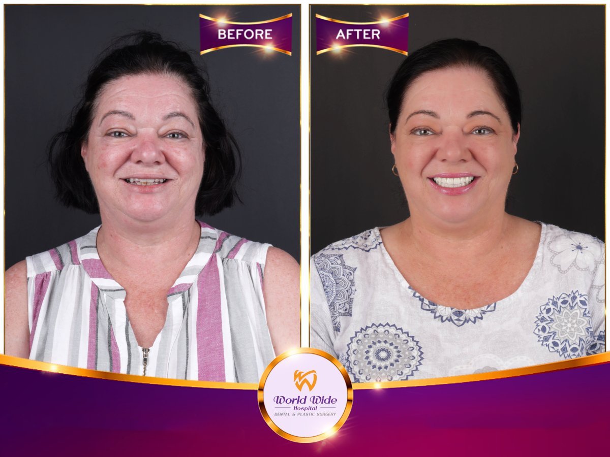 Resultado antes y después de implantes dentales All-on-6 en Worldwide Dental & Plastic Surgery Hospital