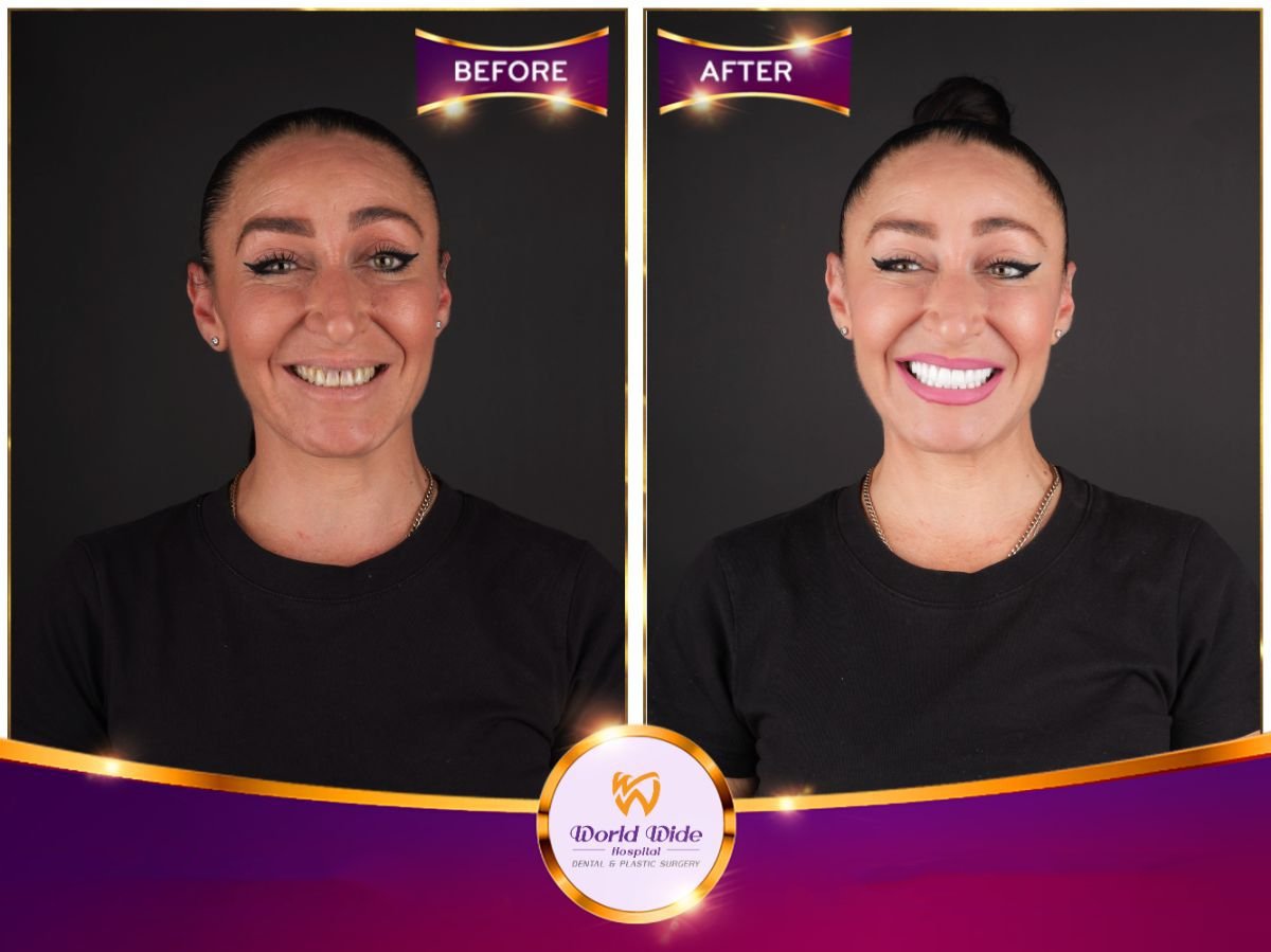 Resultados de antes y después de Hollywood Smile en Worldwide Dental & Plastic Surgery Hospital