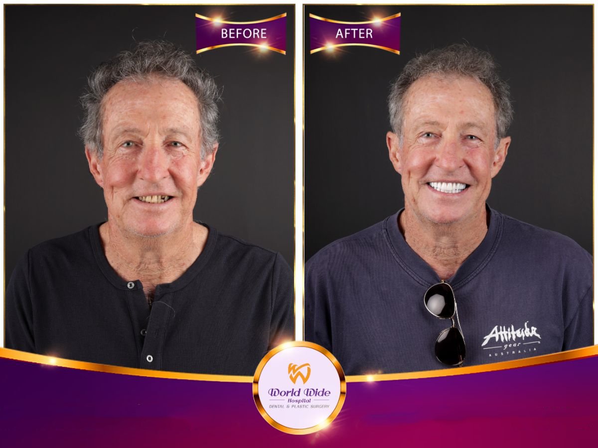 نتائج قبل وبعد ابتسامة هوليود في مستشفى Worldwide Dental & Plastic Surgery