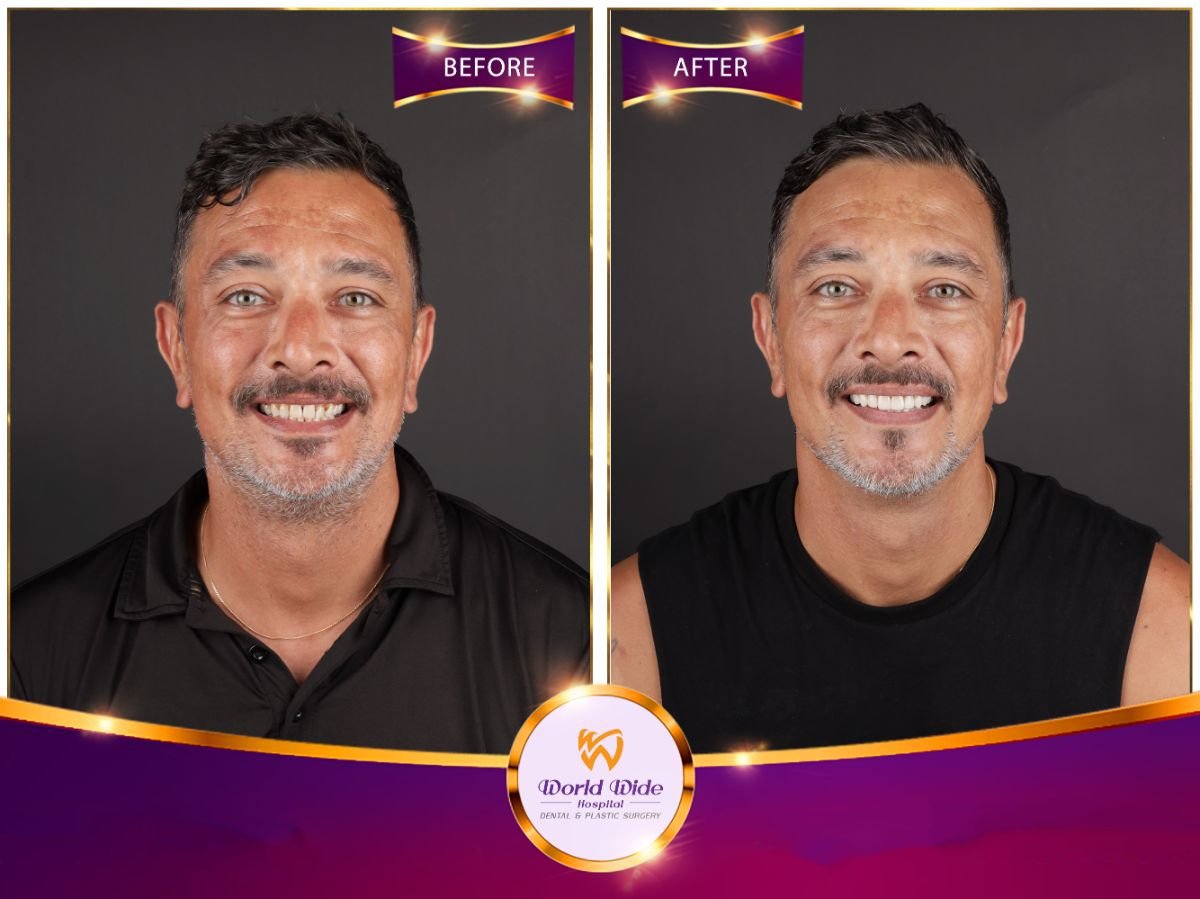 Результаты до и после Hollywood Smile в Worldwide Dental & Plastic Surgery Hospital