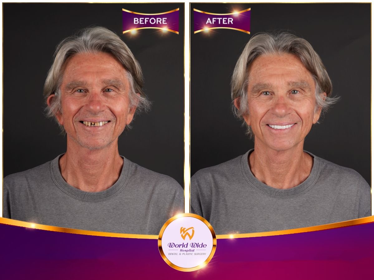 نتائج قبل وبعد ابتسامة هوليوود في مستشفى Worldwide Dental & Plastic Surgery