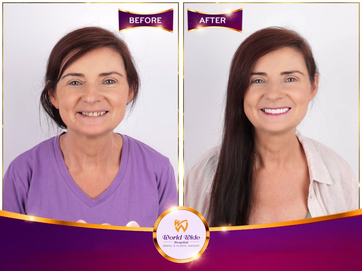 Vorher-nachher-Ergebnis Hollywood Smile bei Worldwide Dental & Plastic Surgery Hospital