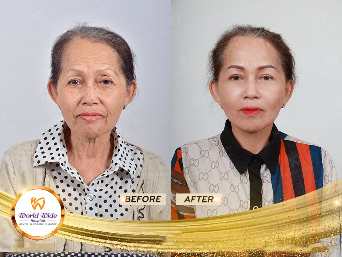 Efekty liftingu twarzy przed i po w Worldwide Dental & Plastic Surgery Hospital, odmłodzenie