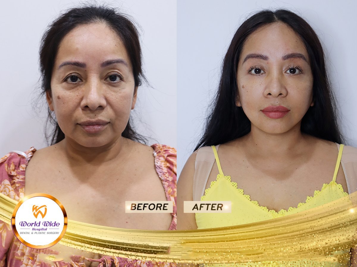 Resultados de lifting facial antes y después en Worldwide Dental & Plastic Surgery Hospital, rejuvenecimiento