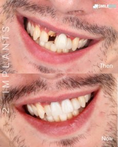Basic Rhinoplasty (nose job) with aEs Code silicone implants All Included - photo 4
