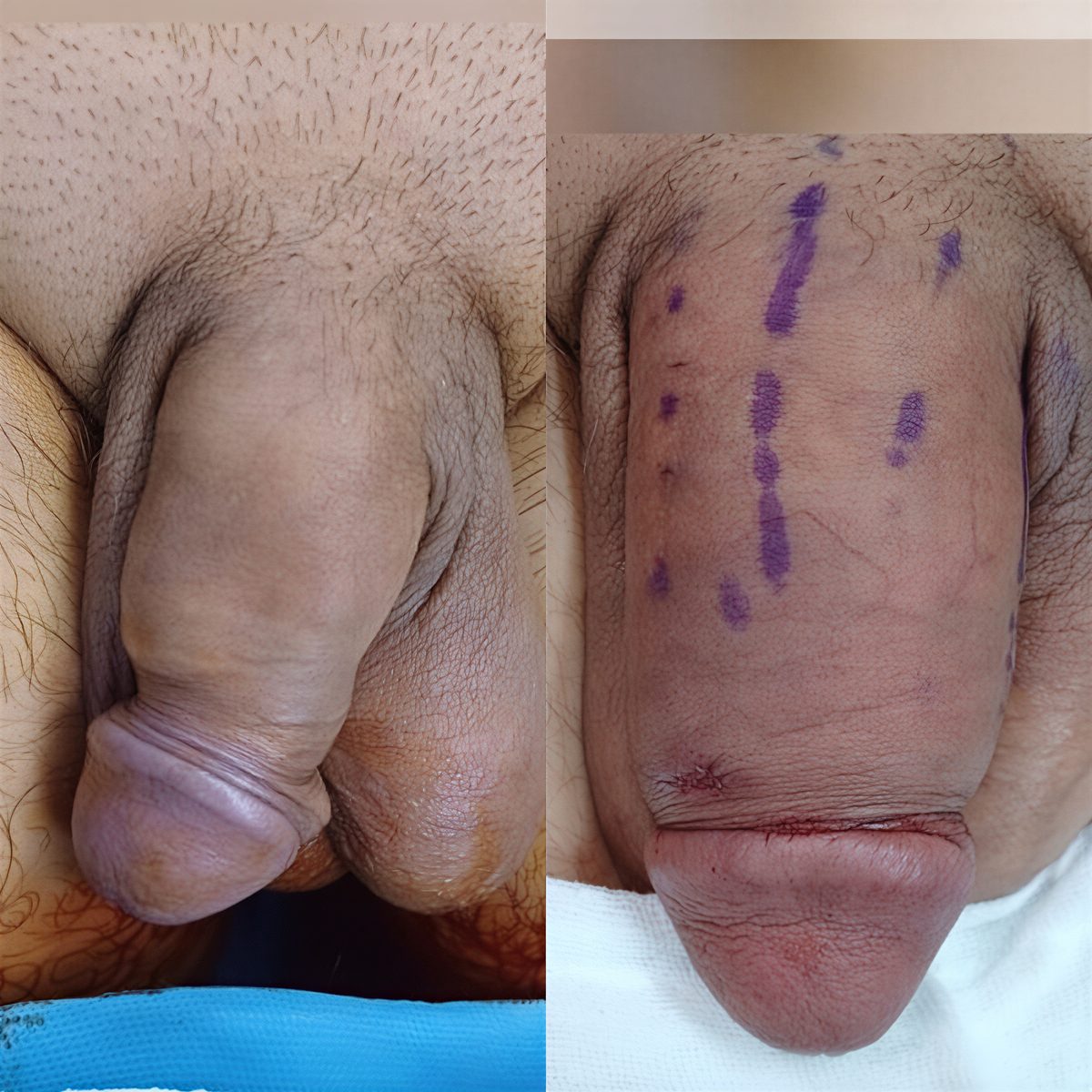 Resultados antes y después de implante de pene en Men's Health Clinics, apariencia mejorada