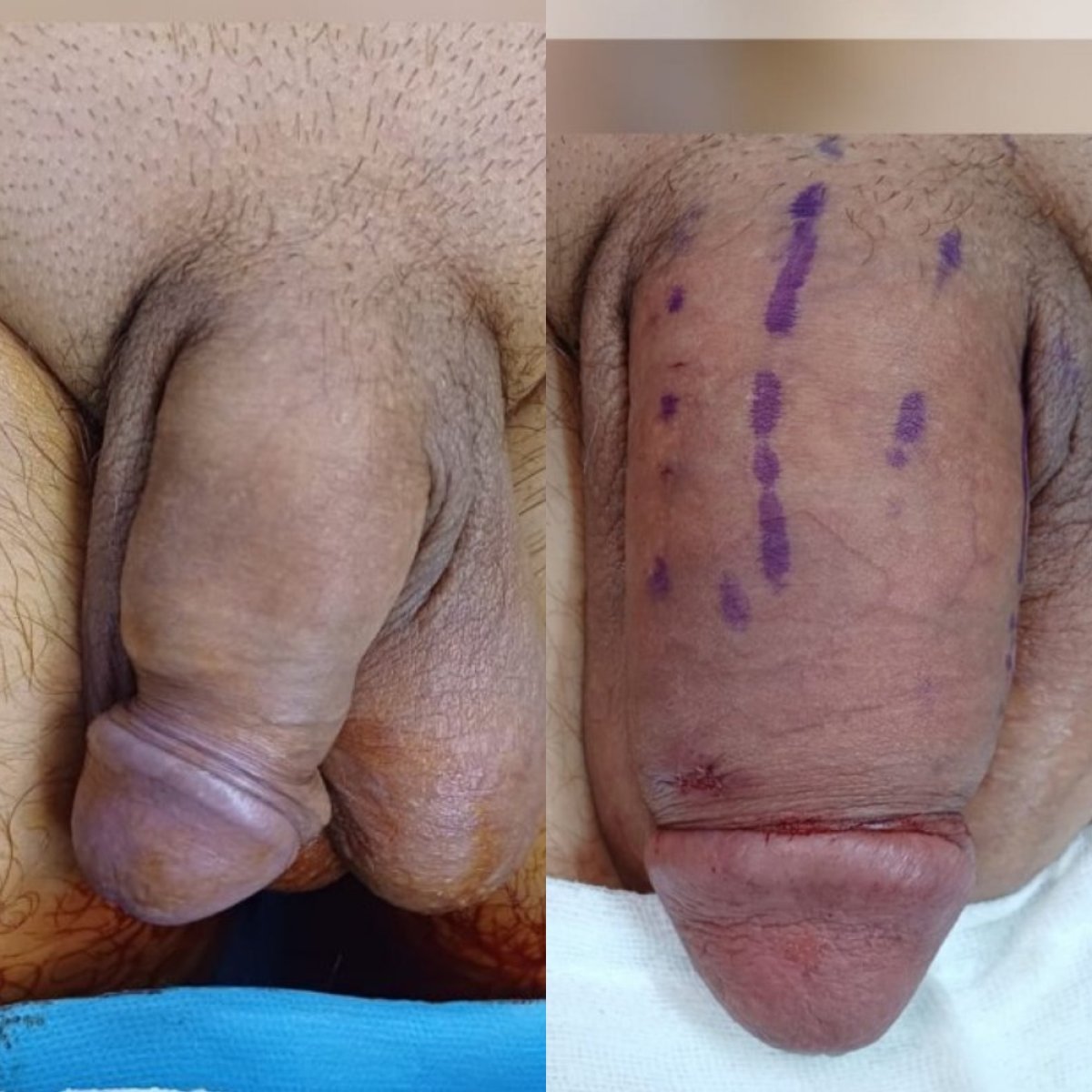 نتائج تكبير القضيب قبل وبعد في Men's Health Clinics، زيادة ملحوظة في الحجم