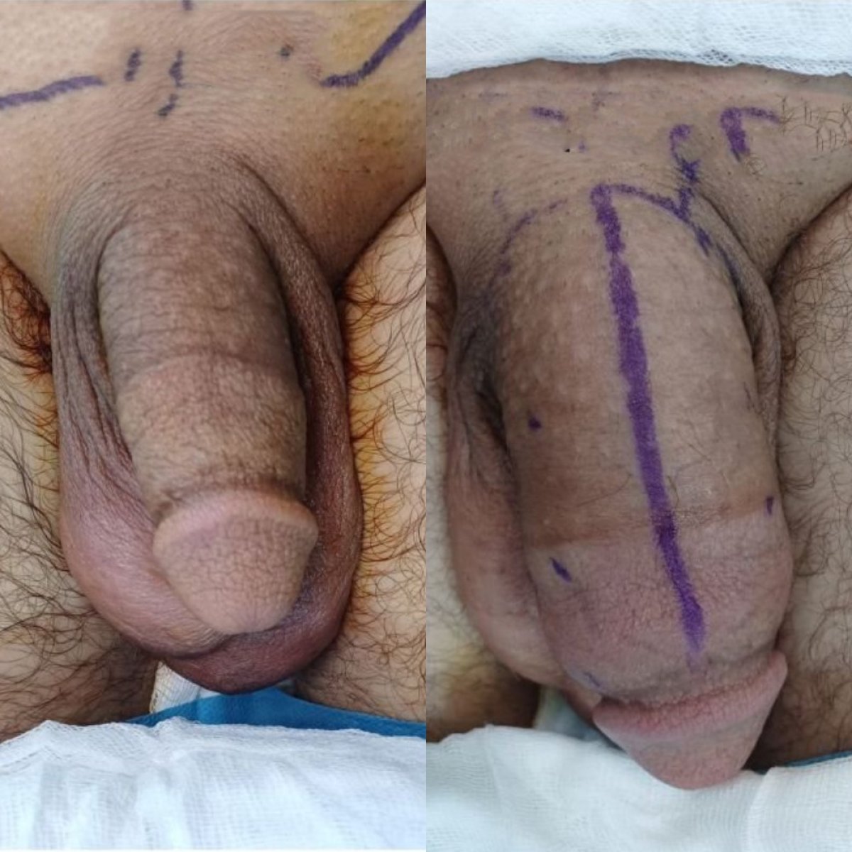 نتائج قبل وبعد تكبير القضيب في Men's Health Clinics – زيادة واضحة في السماكة