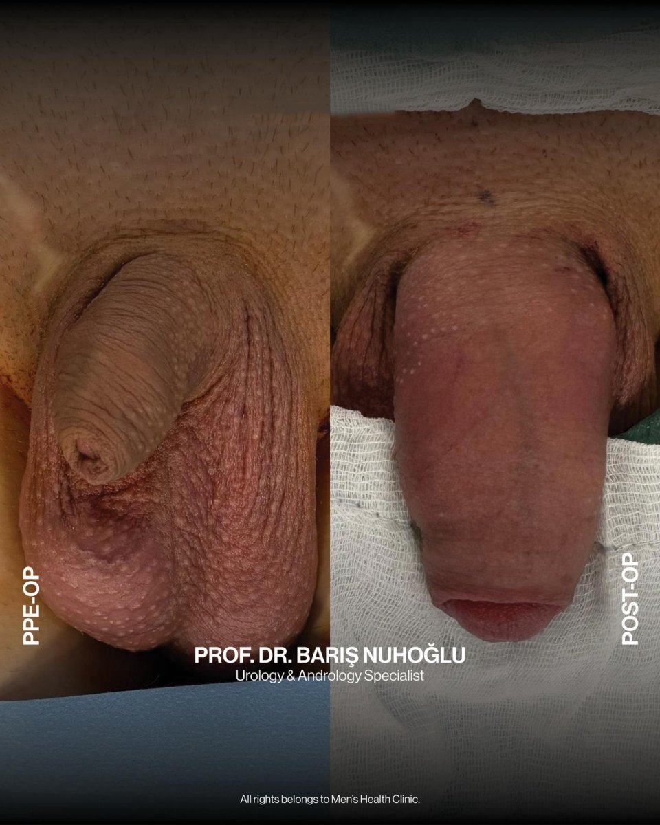 Before and after penis enlargement results at Men's Health Clinics, visible size improvement