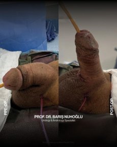 3-Piece Inflatable Penile Implant Surgery — All-Inclusive VIP Package with 1-Year Post-Op Support - photo 5