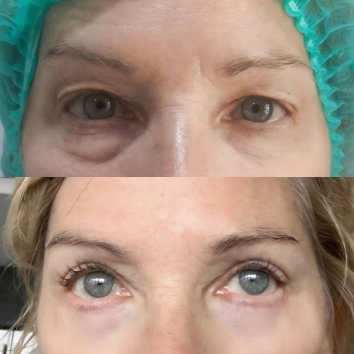 Before and after lower eyelid blepharoplasty results at Charismma Clinic, reduced eye bags