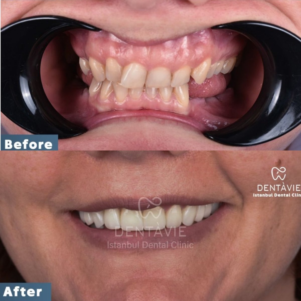 نتيجة قبل وبعد زراعة الأسنان All-on-4 في Dentavie Istanbul Dental Clinic، ابتسامة مستعادة