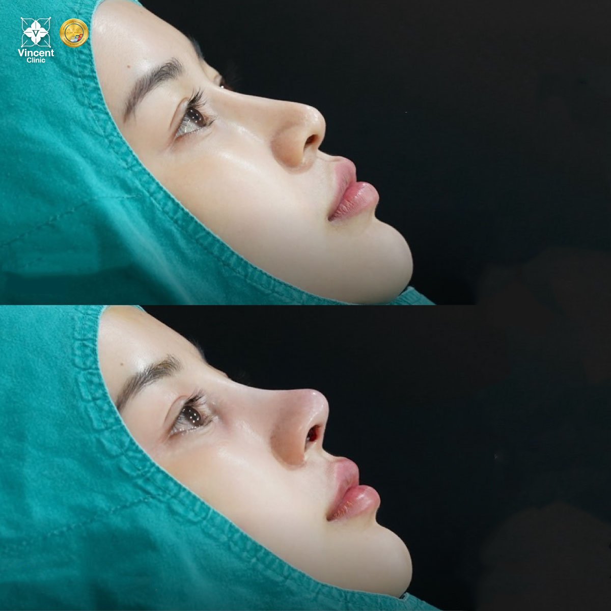 Résultats avant/après rhinoplastie à Vincent Clinic, remodelage du nez et profil amélioré