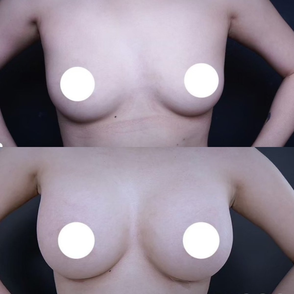 Résultats avant et après augmentation mammaire à Vincent Clinic, forme et taille améliorées