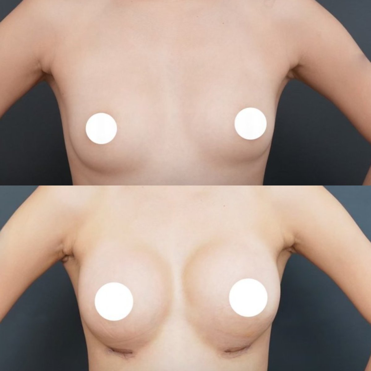 Résultats avant et après augmentation mammaire à la Vincent Clinic, volume accru