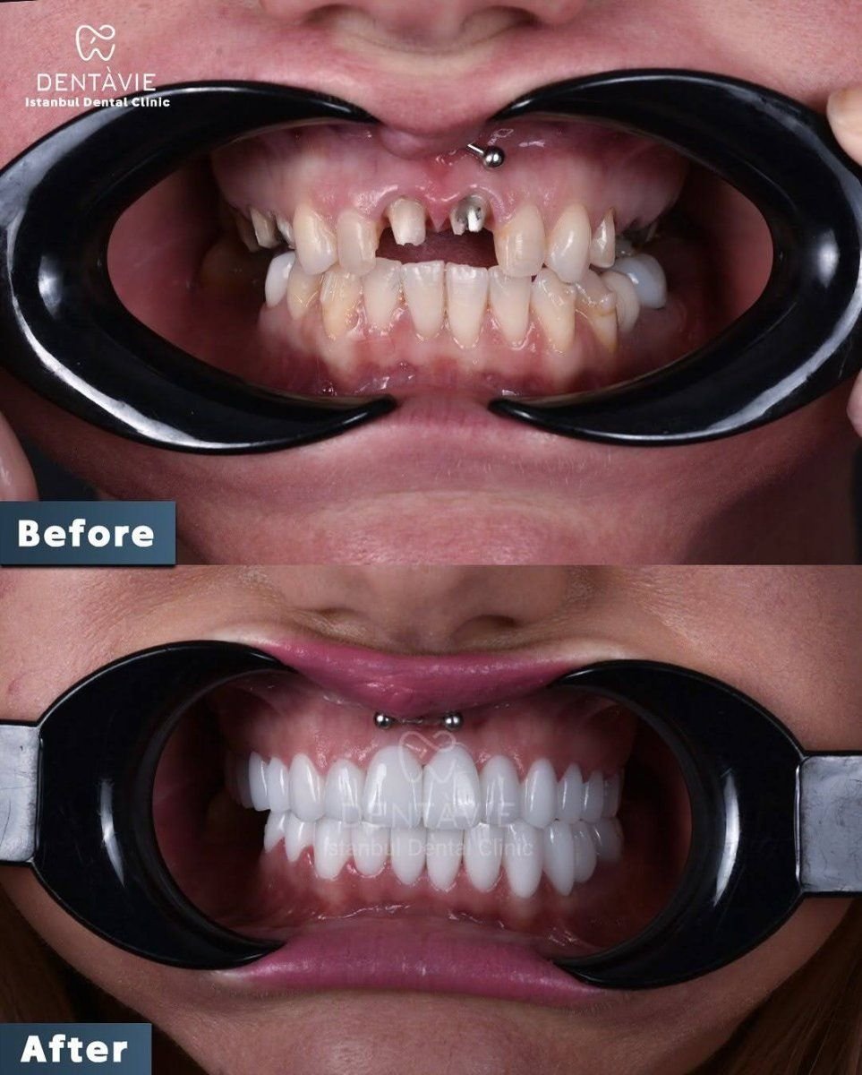 نتائج قبل وبعد زراعة الأسنان All-on-4 في Dentavie Istanbul Dental Clinic
