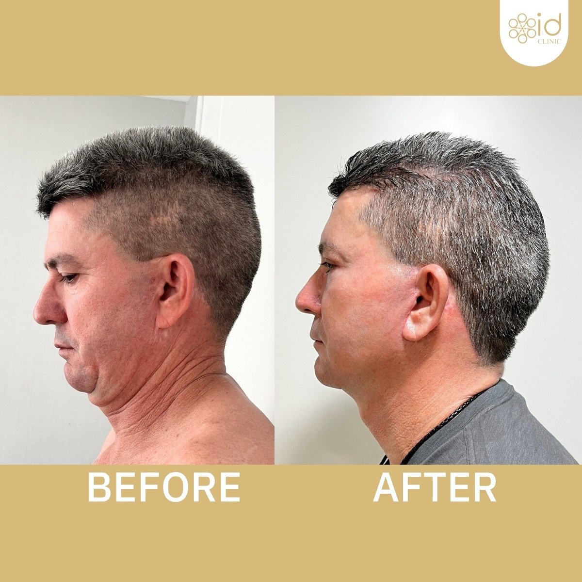 Before and after mini facelift results at ID Clinic Bangkok, visible jawline and neck lift
