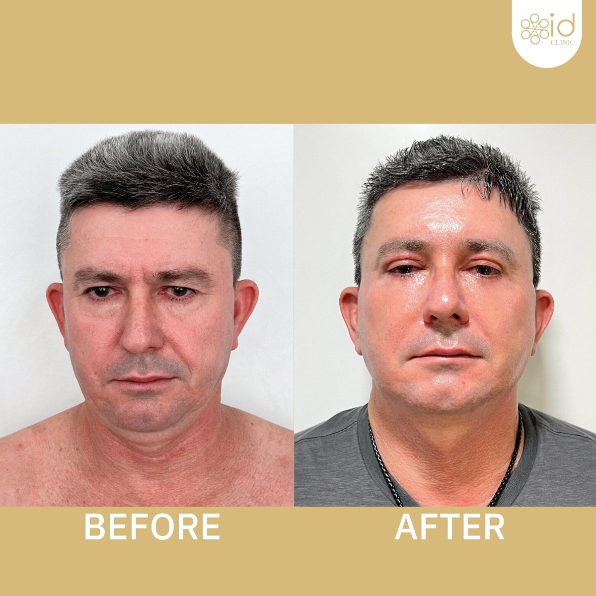 Before and after mini facelift results at ID Clinic Bangkok, visible facial rejuvenation
