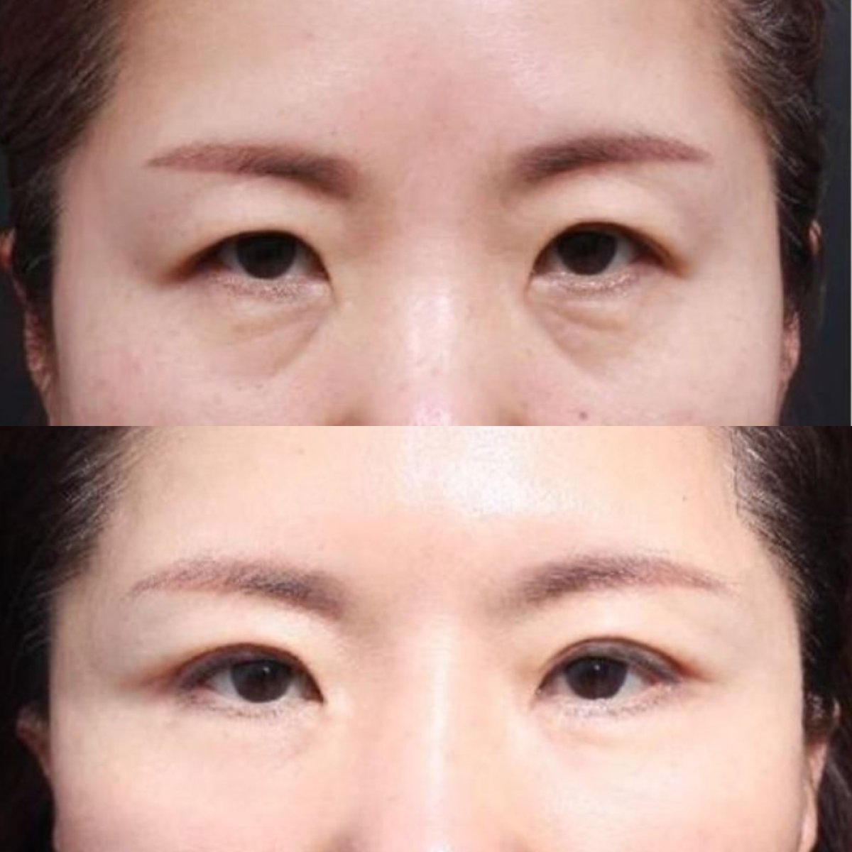 Before and after upper and lower eyelid surgery results at Returning Plastic Surgery clinic