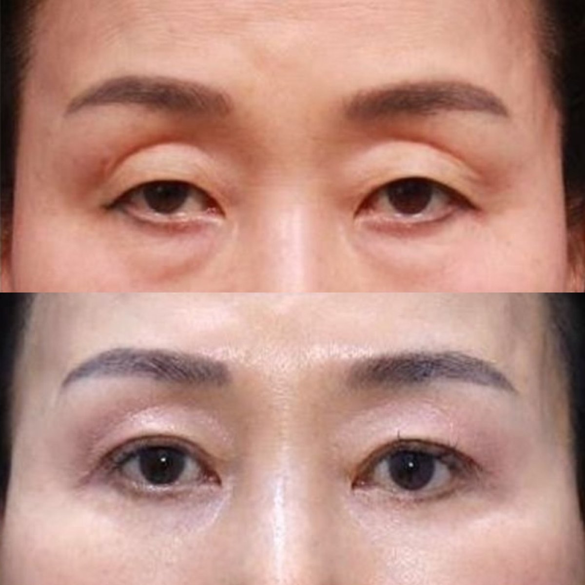 Before and after upper and lower eyelid surgery results at Returning Plastic Surgery clinic