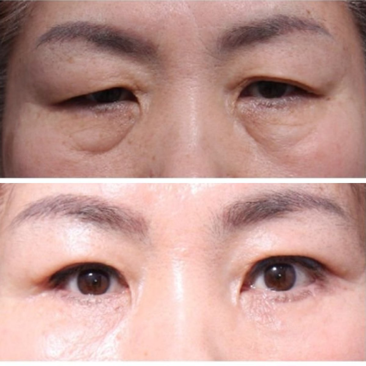 Before and after upper and lower eyelid surgery results at Returning Plastic Surgery clinic