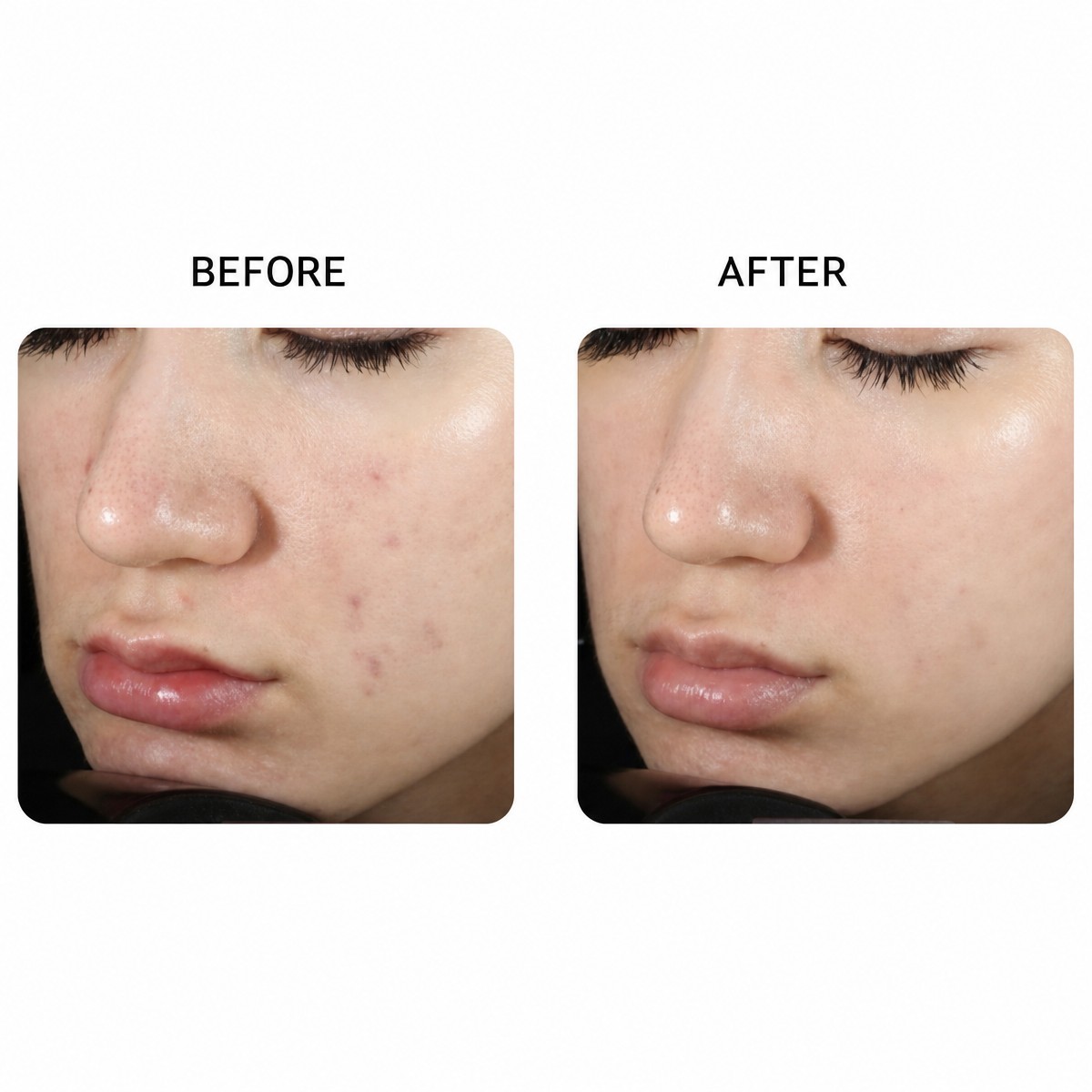 Before and after laser skin resurfacing at STC Clinic, improved facial skin texture result