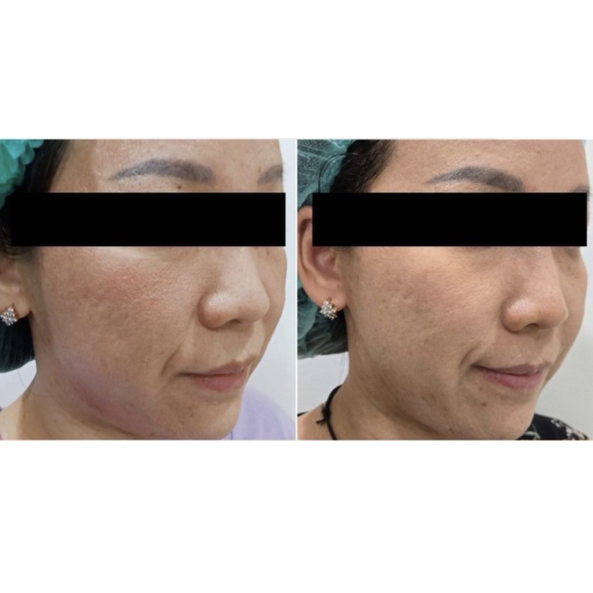 Before and after laser skin resurfacing at STC Clinic, improved facial skin texture result