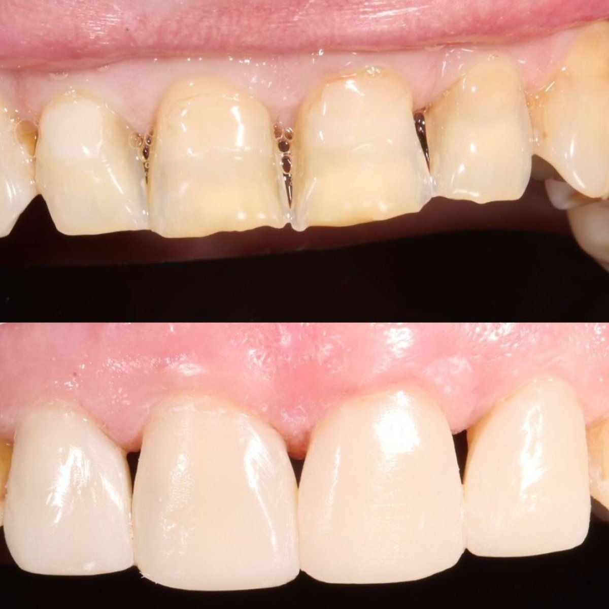 نتائج قبل وبعد ترابط الأسنان في Smile Centrum – ترميم الأسنان وتحسين الابتسامة