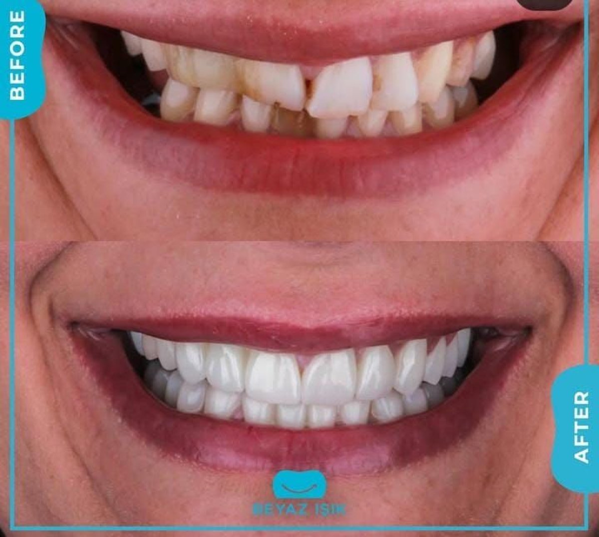 Результати до і після Smile makeover в Adem and Havva Medical Center, вирівняні зуби