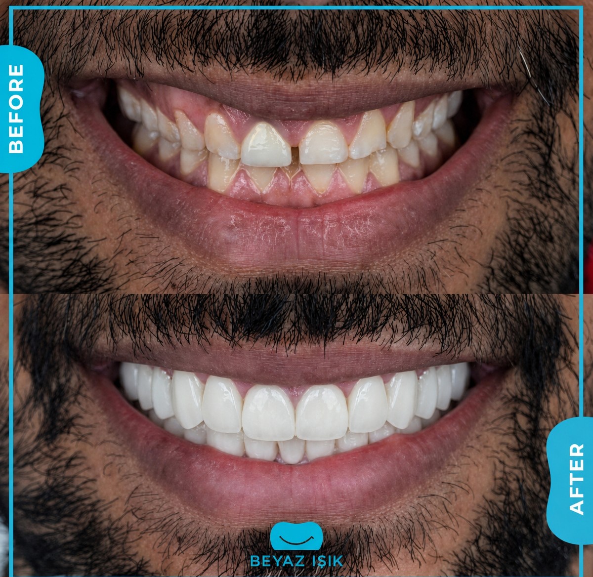 نتائج تجميل الابتسامة قبل وبعد في مركز آدم وحواء الطبي، أسنان بيضاء محسنة