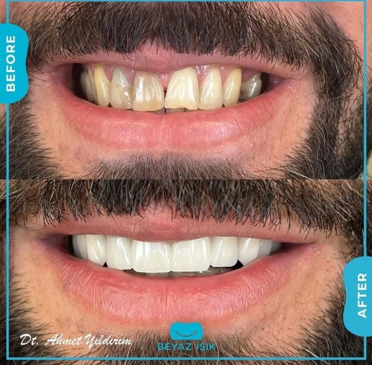 نتائج تجميل الابتسامة قبل وبعد في مركز آدم وحواء الطبي، أسنان بيضاء ومتناسقة