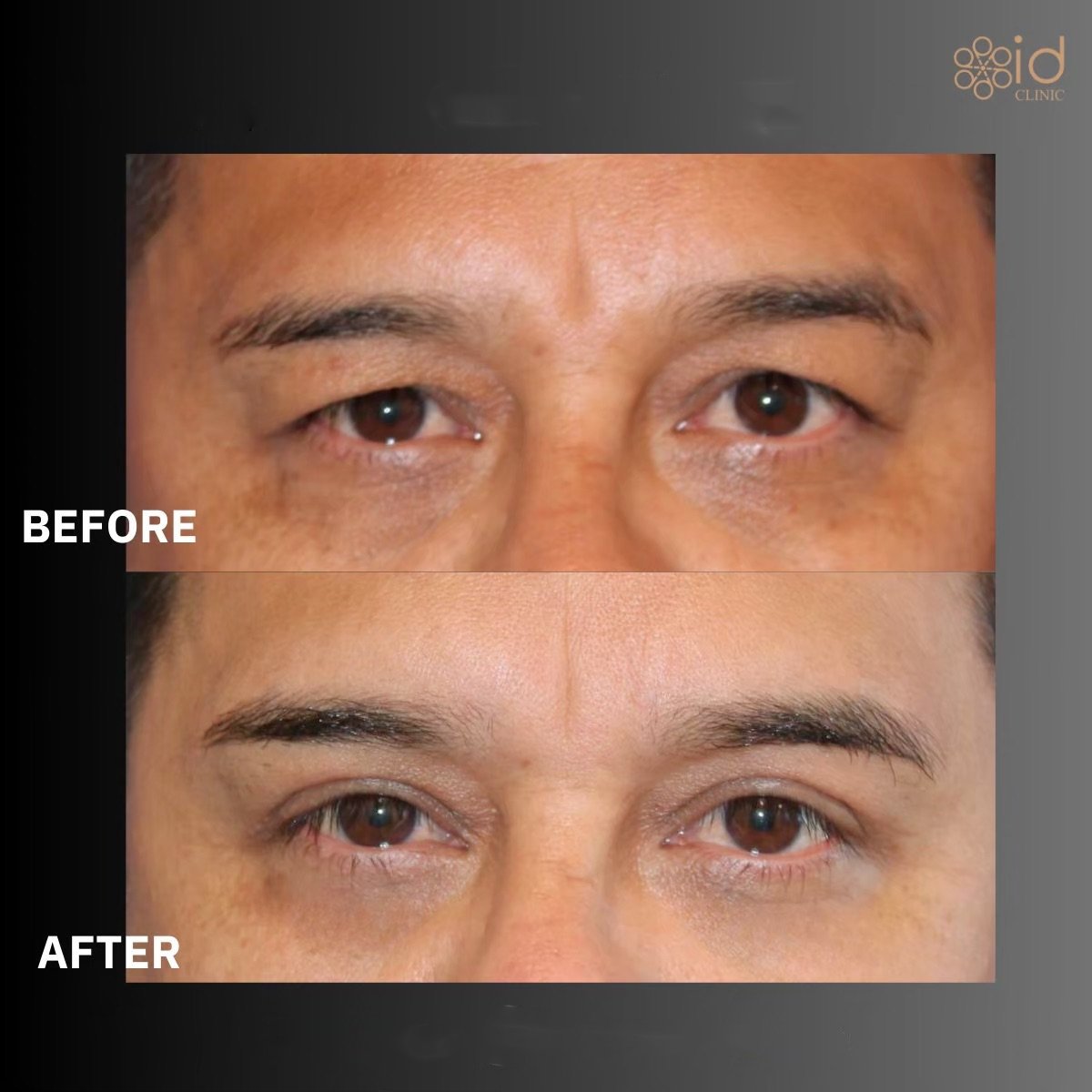 Before and after blepharoplasty results at ID Clinic Bangkok, eyelid correction for men