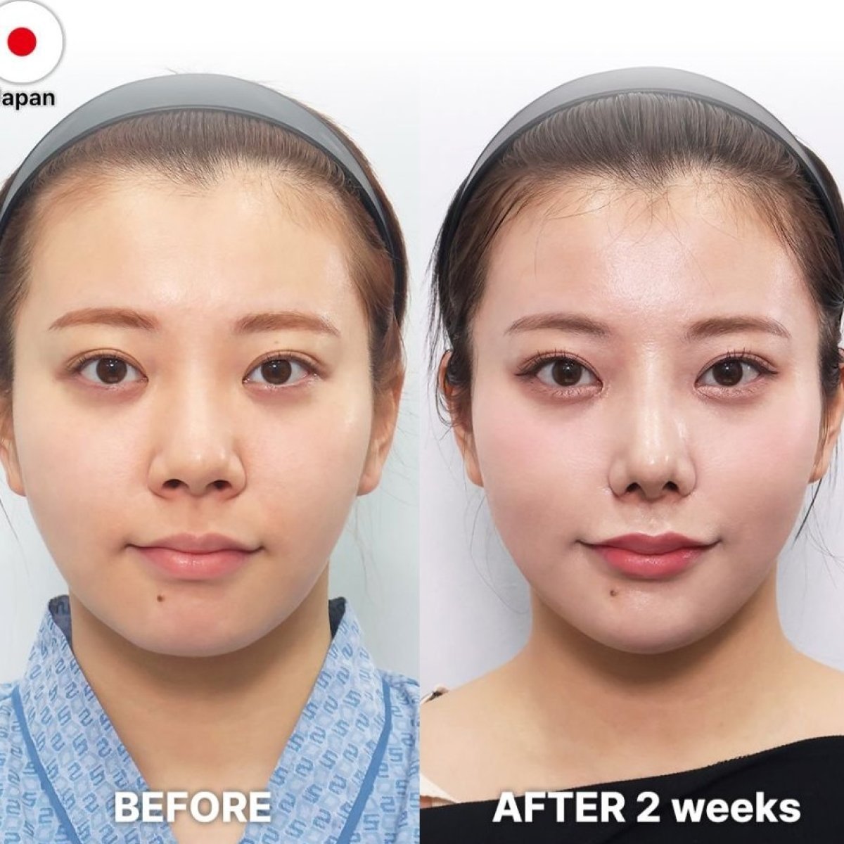 Before and after revision rhinoplasty results at Returning Plastic Surgery, improved nose shape
