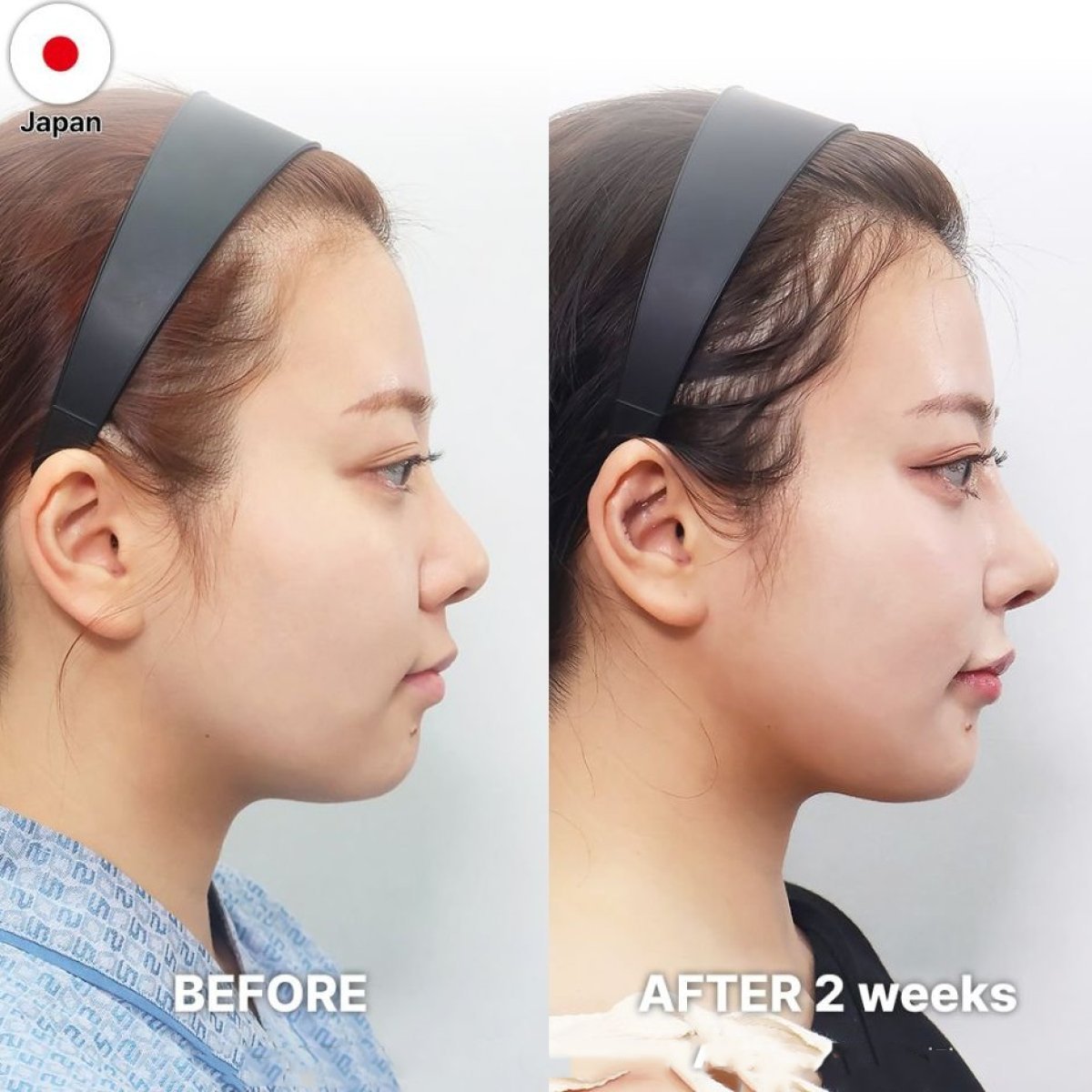 Результаты до и после риносептопластики в Returning Plastic Surgery, улучшен профиль носа