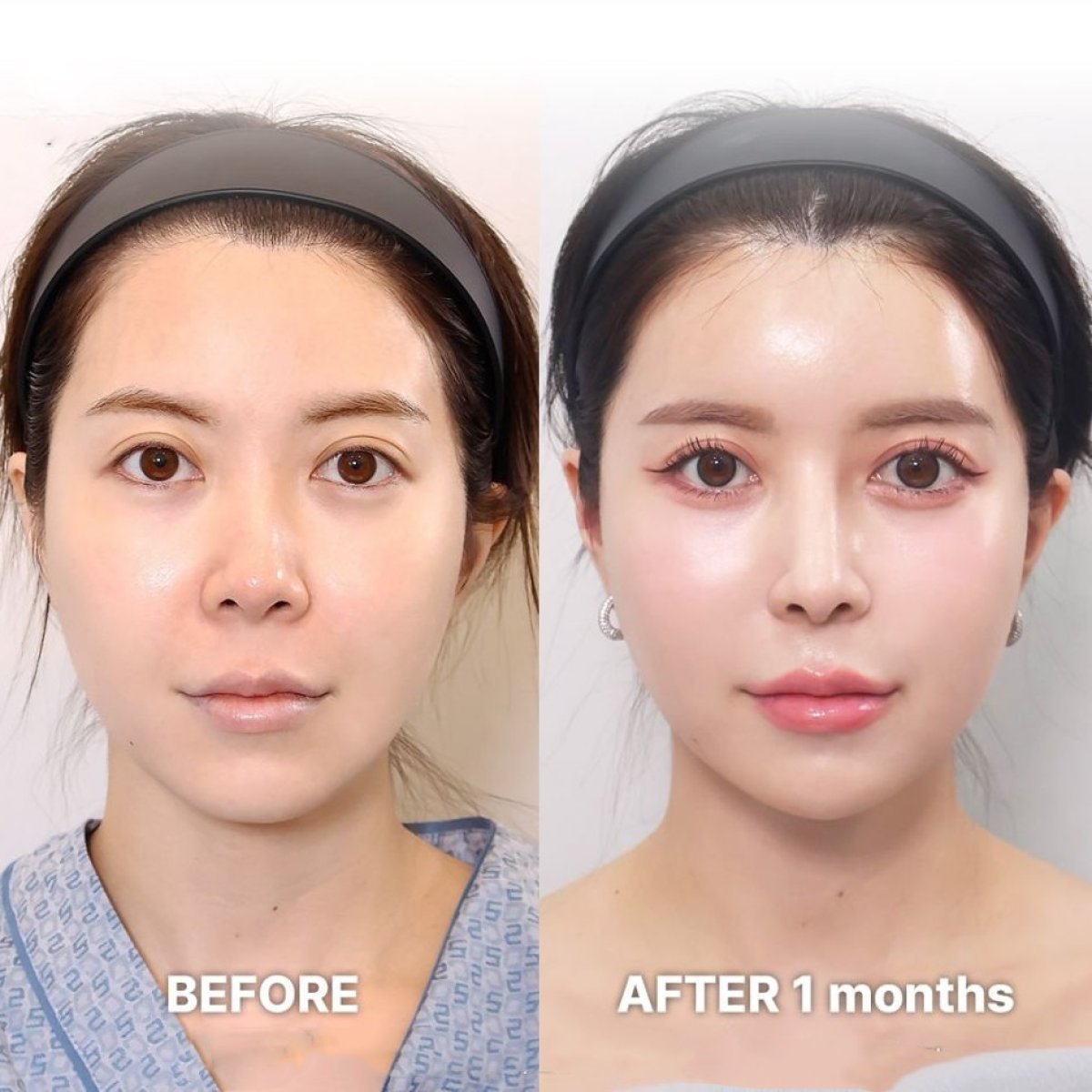 Before and after revision rhinoplasty result at Returning Plastic Surgery, nose reshaping outcome