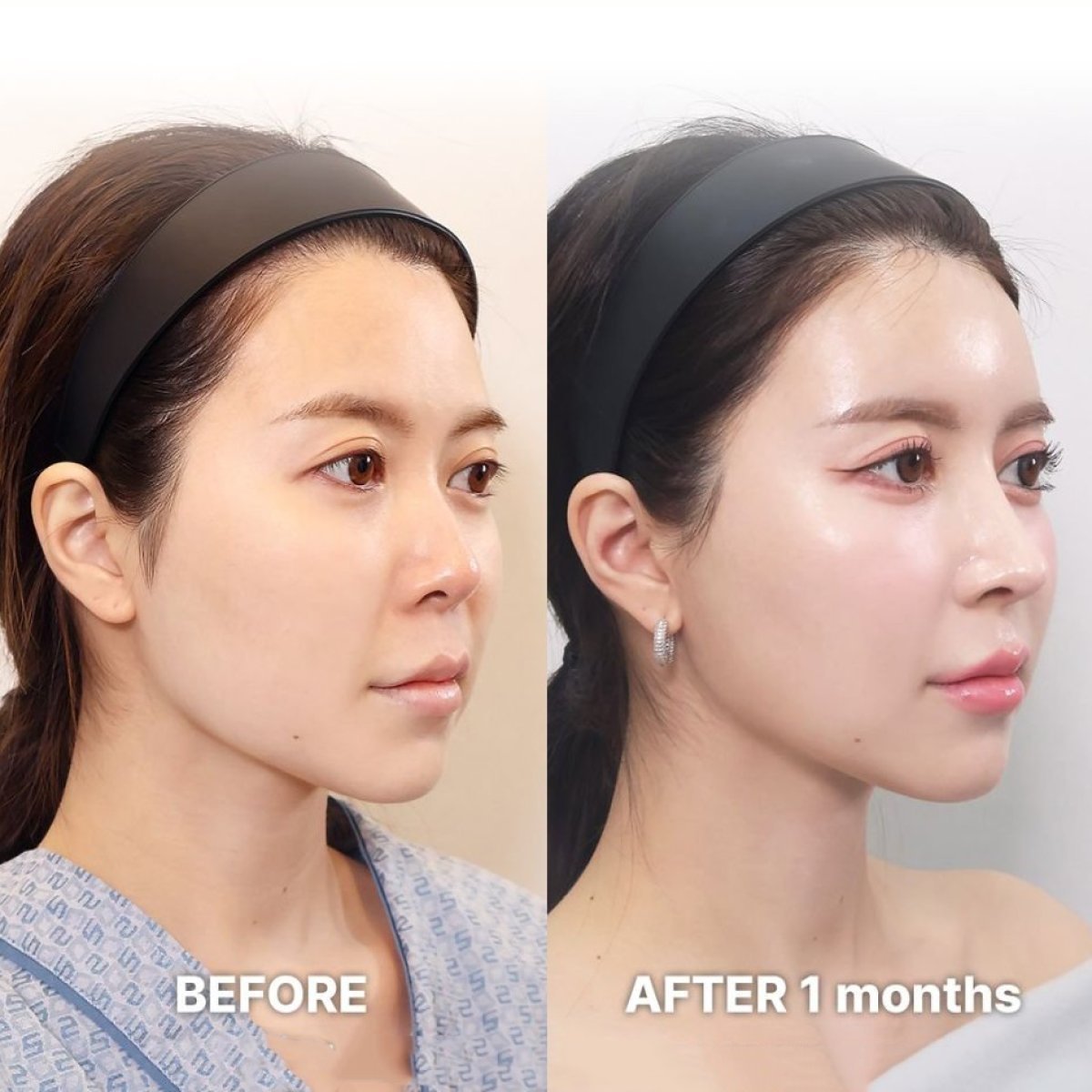 Before and after revision rhinoplasty result at Returning Plastic Surgery, improved nose shape