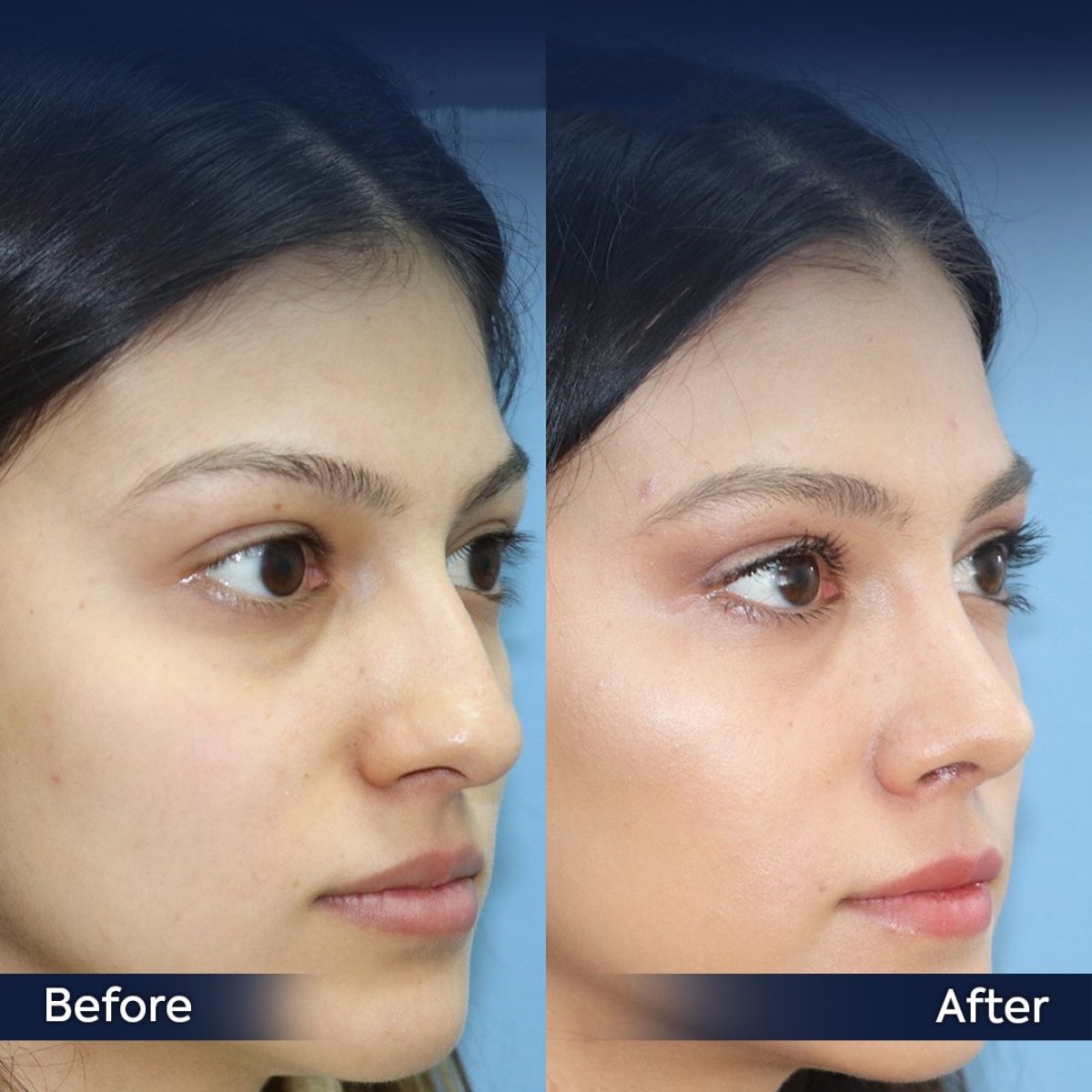 نتائج قبل وبعد عملية تجميل الأنف التصحيحية في عيادة Dr. Safa Manav، تحسين شكل الأنف