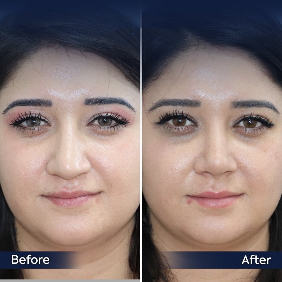 Resultados antes y después de rinoplastia de revisión en Dr. Safa Manav Clinic, forma de nariz mejorada