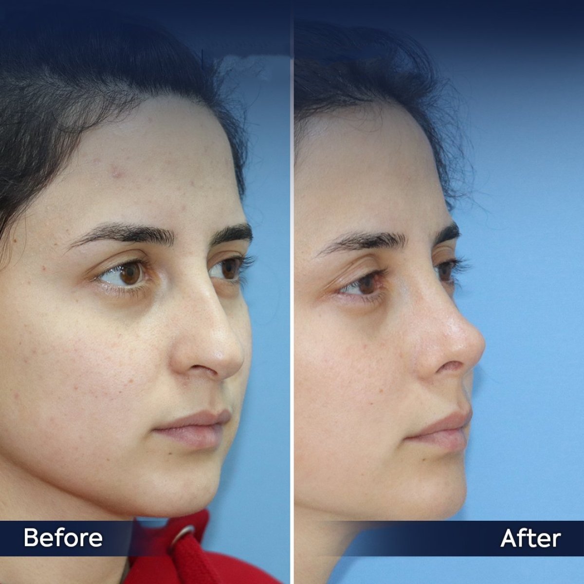 Résultats avant/après rhinoplastie secondaire à la clinique Dr. Safa Manav, forme du nez améliorée