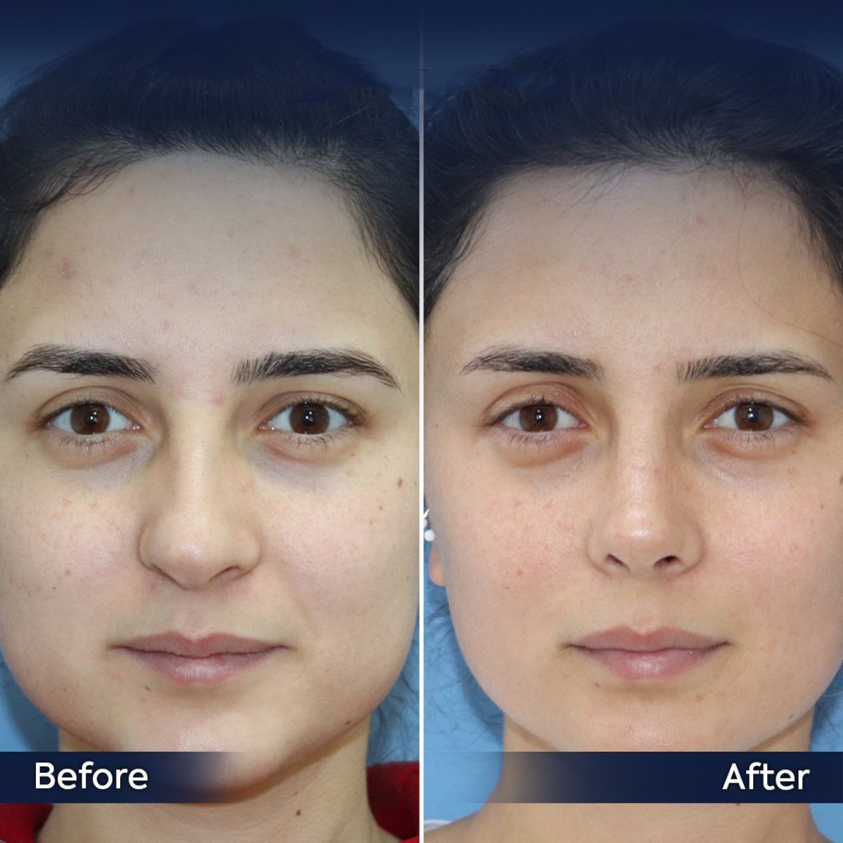 Resultados de rinoplastia de revisión antes y después en Dr. Safa Manav Clinic, forma de nariz mejorada