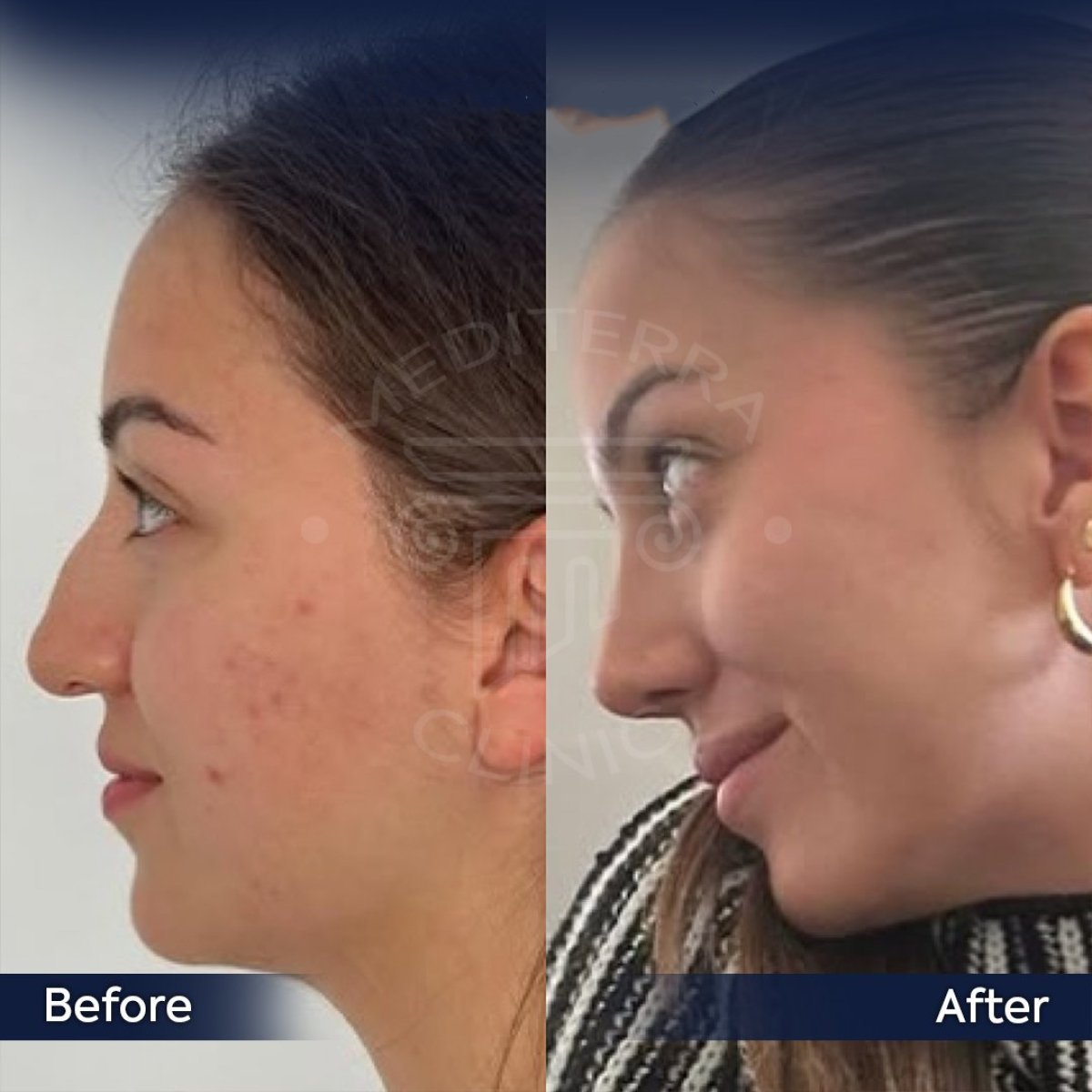 نتائج تجميل الأنف التصحيحي قبل وبعد في عيادة Dr. Safa Manav، تحسين شكل الأنف