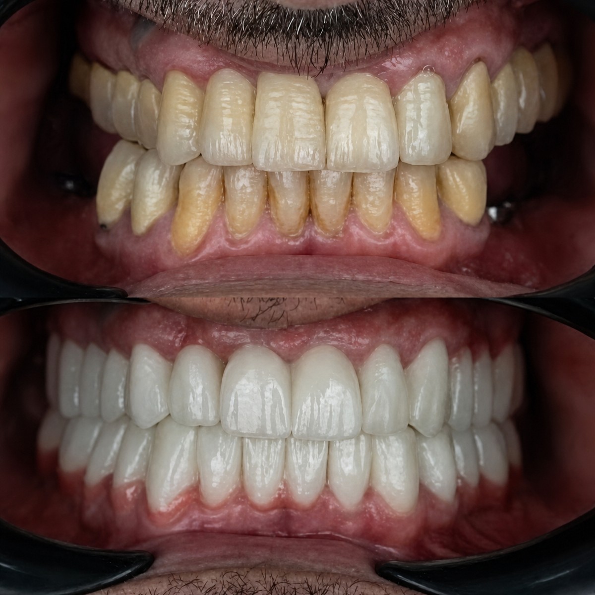 Результати до і після Smile makeover в Adem and Havva Medical Center, білі рівні зуби