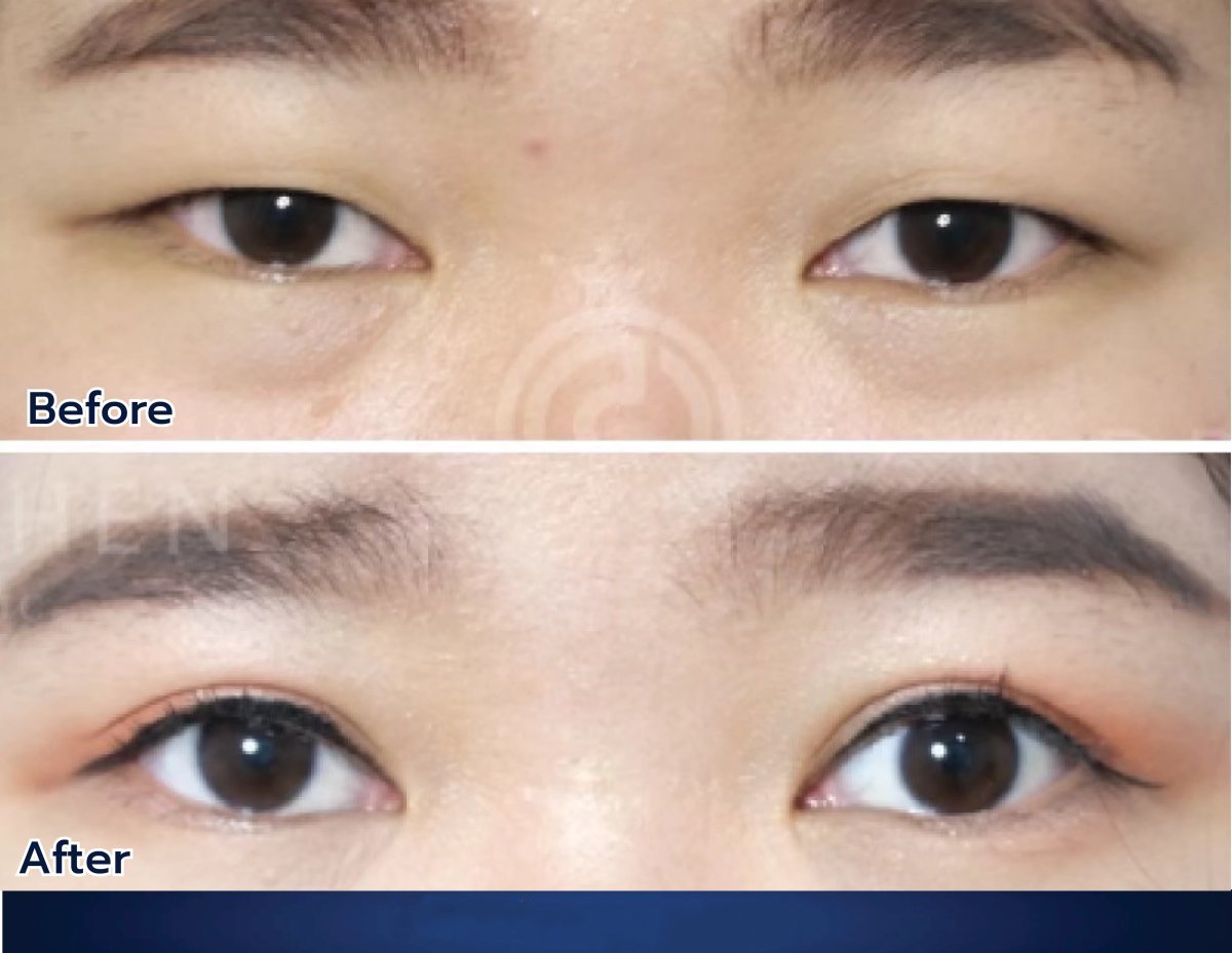 نتائج رأب الجفن قبل وبعد في Dr. Chen Surgery Hospital International Center