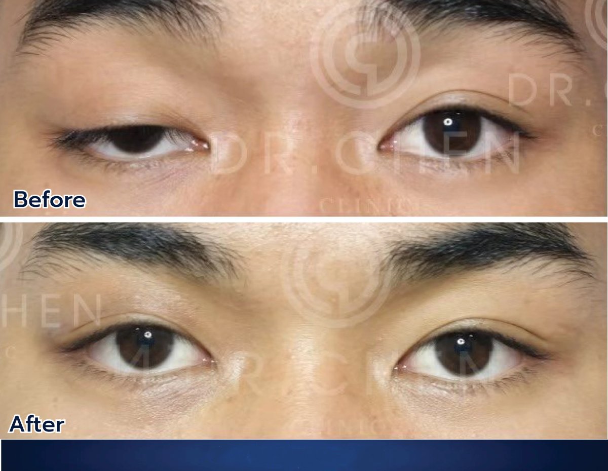Результаты блефаропластики до и после в Dr. Chen Surgery Hospital International Center