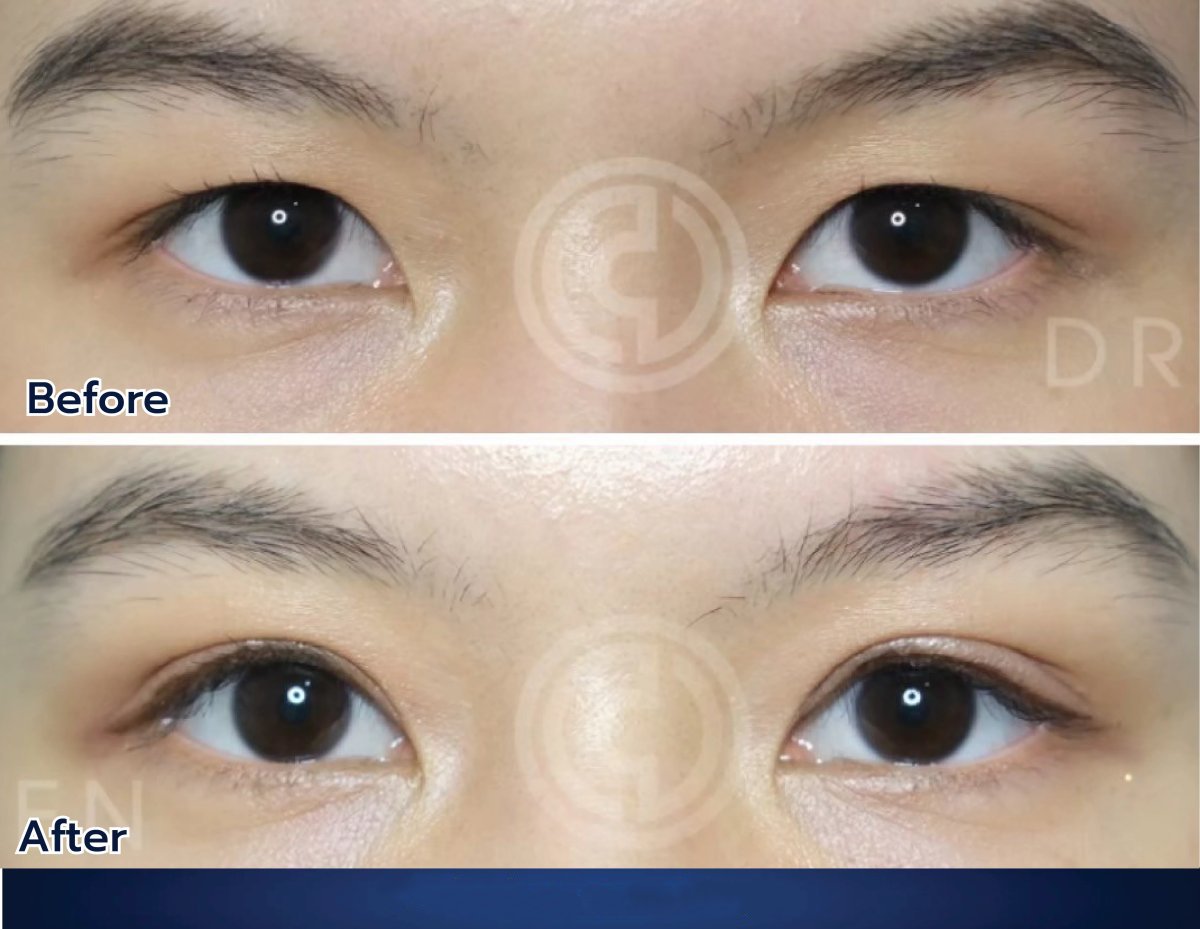 نتائج رأب الجفن قبل وبعد في Dr. Chen Surgery Hospital International Center