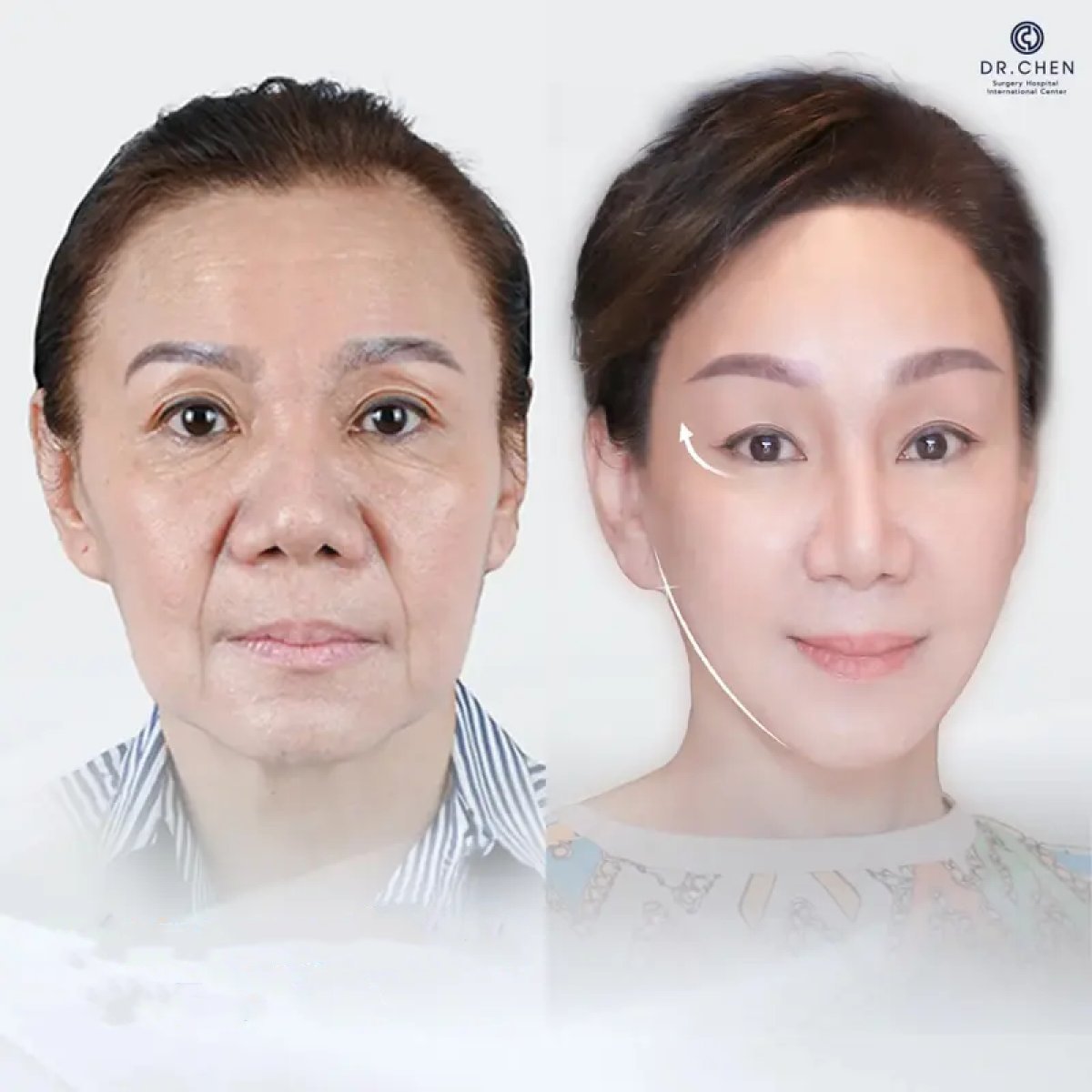 نتائج شد الوجه قبل وبعد في Dr. Chen Surgery Hospital International Center، تجديد شباب الوجه