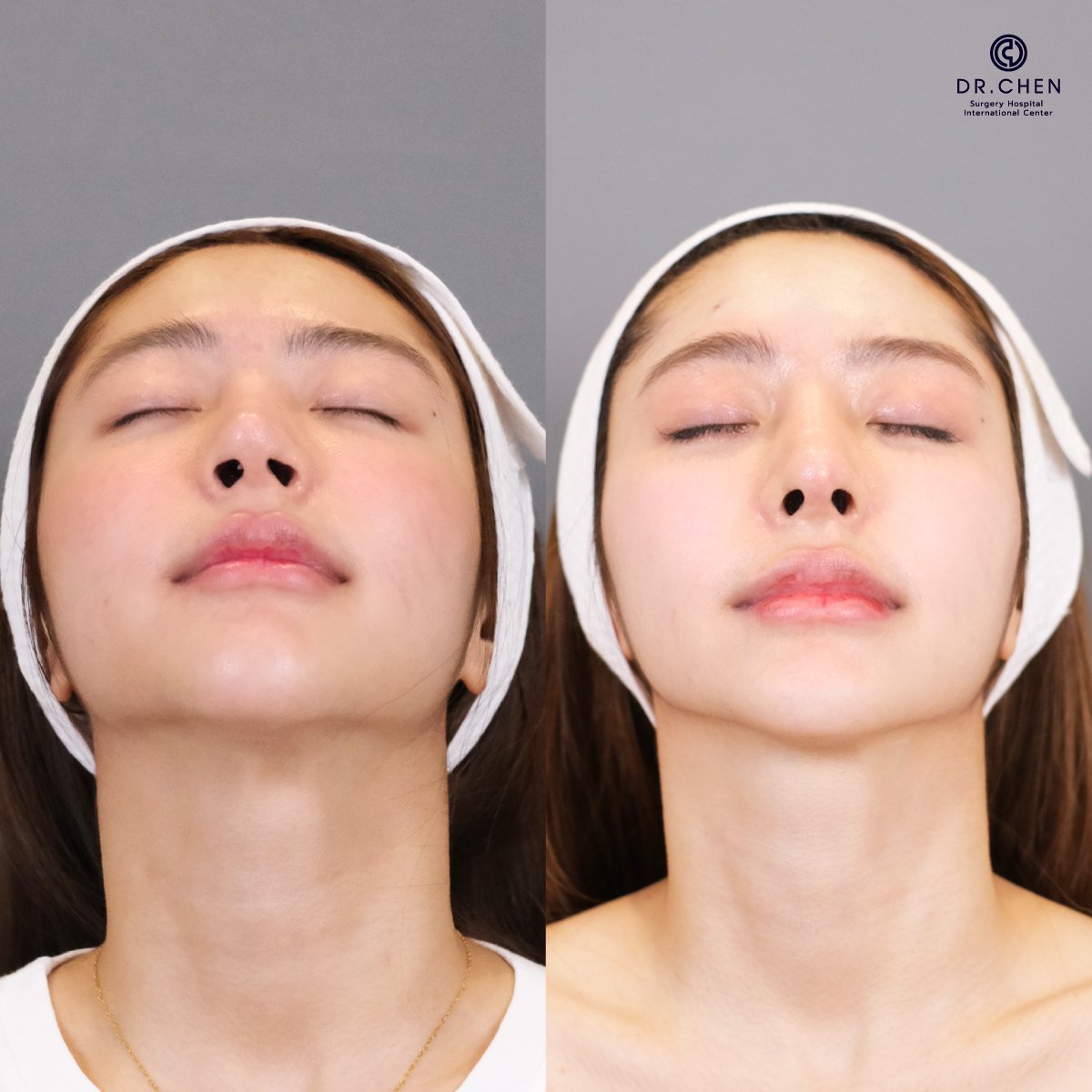 Résultat avant et après rhinoplastie secondaire au Dr. Chen Surgery Hospital International Center