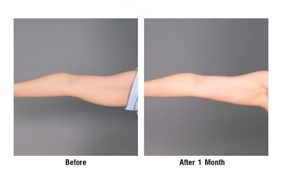 Результаты липосакции рук до и после в Dr. Chen Surgery Hospital International Center