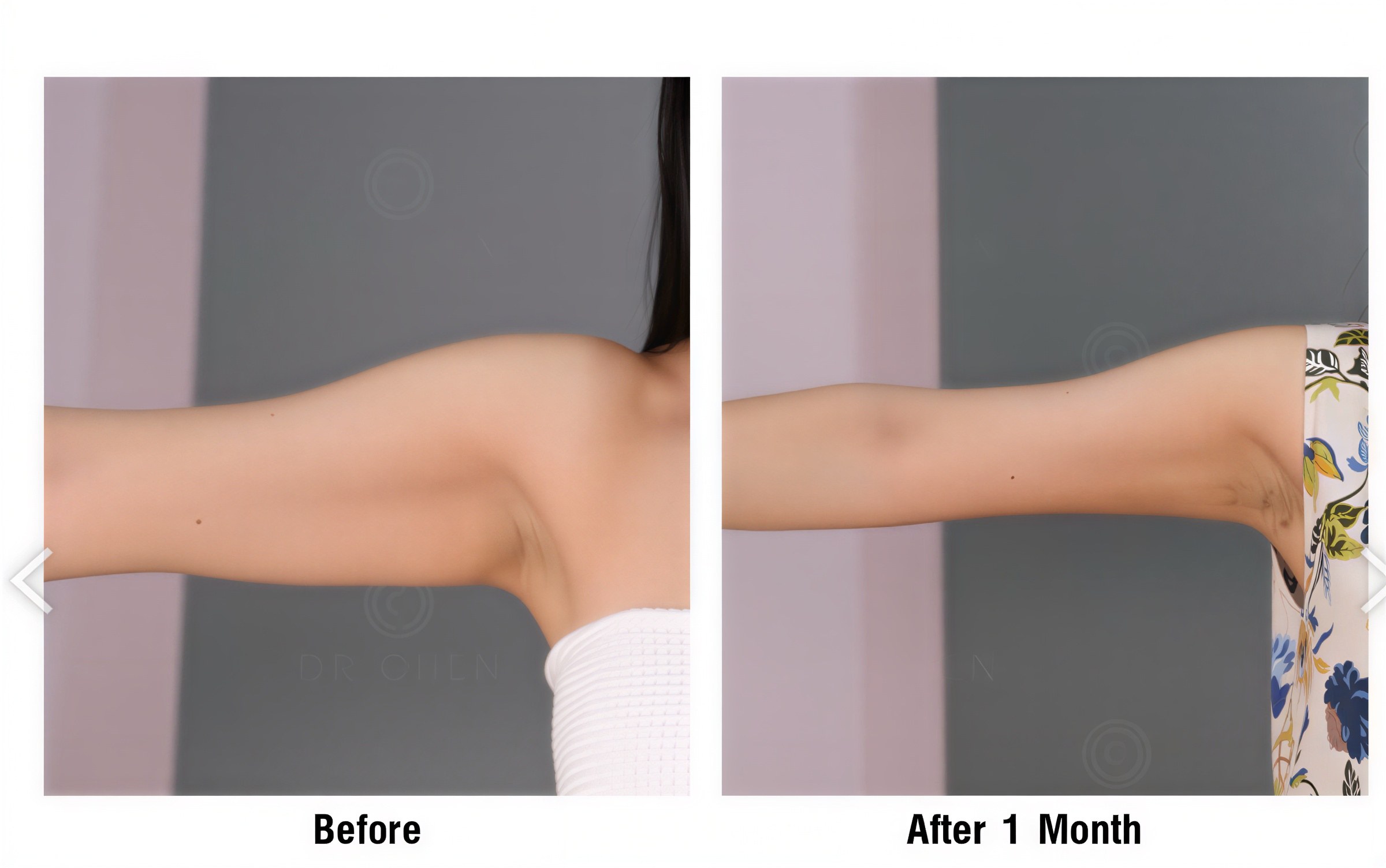Resultado de liposucción de brazo antes y después en Dr. Chen Surgery Hospital International Center