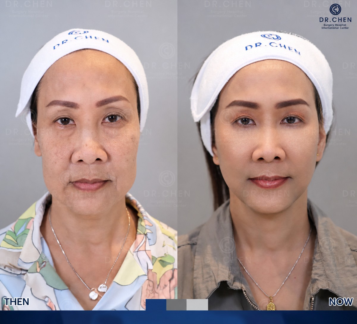 Результат до и после липофилинга лица в Dr. Chen Surgery Hospital International Center